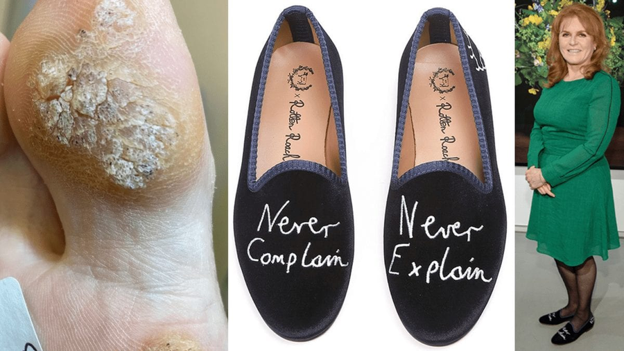 Sarah Ferguson footwear verruca Never Complain Never Explain